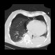 Pneumomediastinum, pneumothorax, PNO, subcutaneous emphysema: CT - Computed tomography